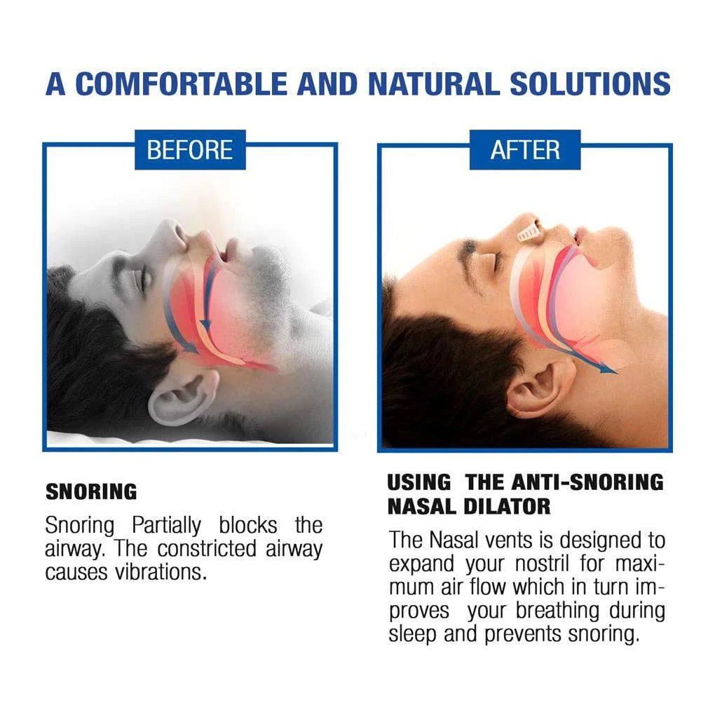 New Blue Silicone 4/8PCS/set Snoring Solution Anti Snoring Devices Snore Nose Vents Nasal Dilators For Better Sleep Sleeping Aid - zzzleep.fi